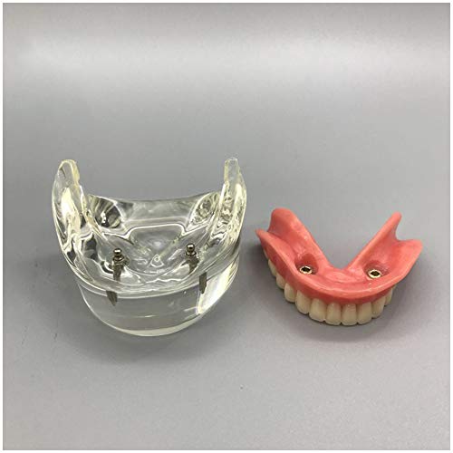 WJH Modelo Dental - Implantes Dentales - sobredentadura Mandibular Inferior 2 Implantes Demo para la enseñanza y estudiar